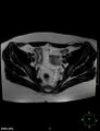 Cesarian scar endometriosis (Radiopaedia 68495-78066 Axial T2 8).jpg