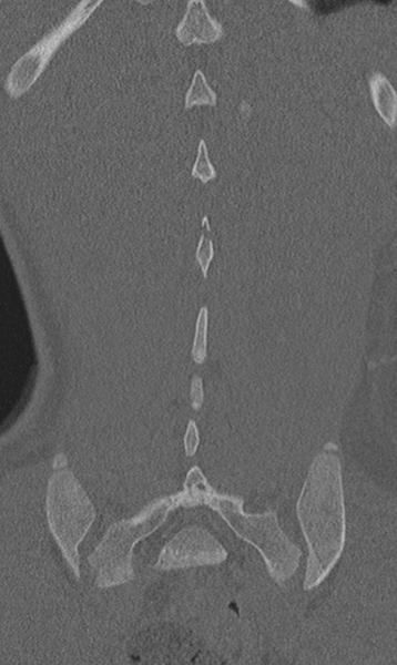 File:Chance fracture (Radiopaedia 40360-42912 Coronal bone window 58).png