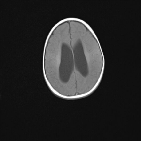 File:Chiari III malformation with occipital encephalocele (Radiopaedia 79446-92559 Axial T1 19).jpg