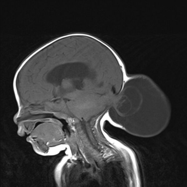 File:Chiari III malformation with occipital encephalocele (Radiopaedia 79446-92559 Sagittal T1 12).jpg