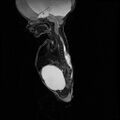 Chiari II malformation with spinal meningomyelocele (Radiopaedia 23550-23652 Sagittal T2 5).jpg