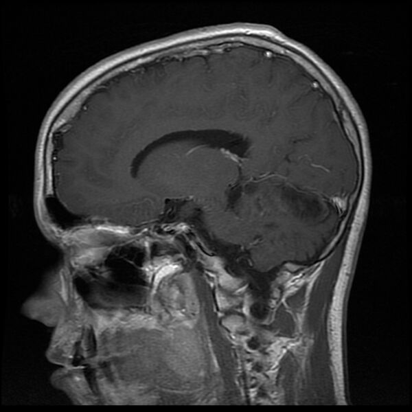File:Chiasmatic-hypothalamic juvenile pilocytic astrocytoma (Radiopaedia 78533-91236 Sagittal T1 C+ 15).jpg