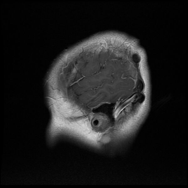 File:Chiasmatic-hypothalamic juvenile pilocytic astrocytoma (Radiopaedia 78533-91236 Sagittal T1 C+ 23).jpg