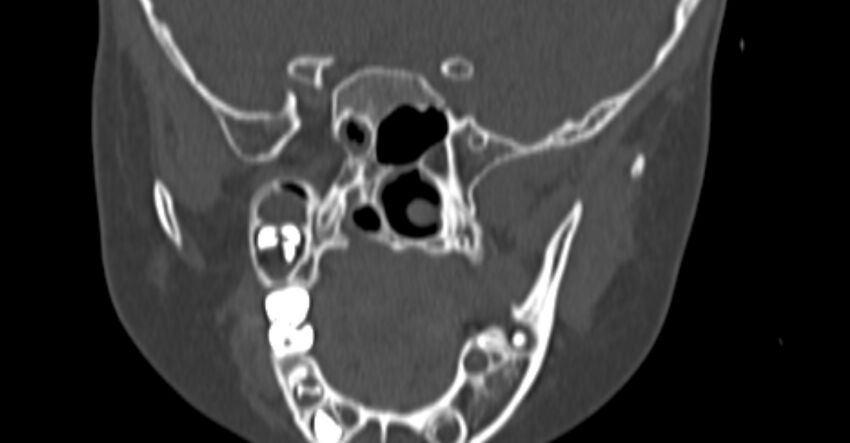 Choanal atresia (Radiopaedia 51295-56972 Coronal bone window 73).jpg