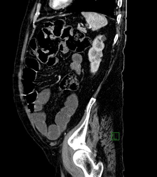 File:Cholangiocarcinoma with cerebral metastases (Radiopaedia 83519-98629 F 32).jpg