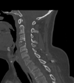 Chordoma (C4 vertebra) (Radiopaedia 47561-52188 Sagittal bone window 36).png
