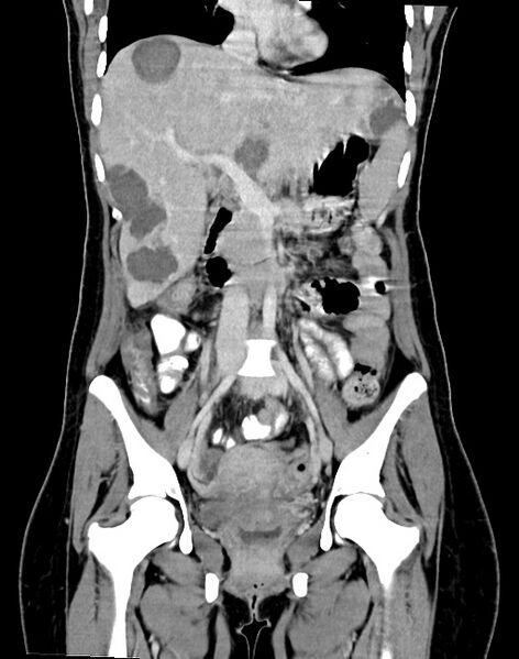 File:Choriocarcinoma liver metastases (Radiopaedia 74768-85766 B 51).jpg