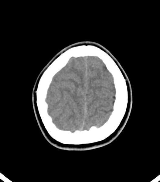 File:Choroid plexus carcinoma (Radiopaedia 91013-108552 Axial non-contrast 53).jpg