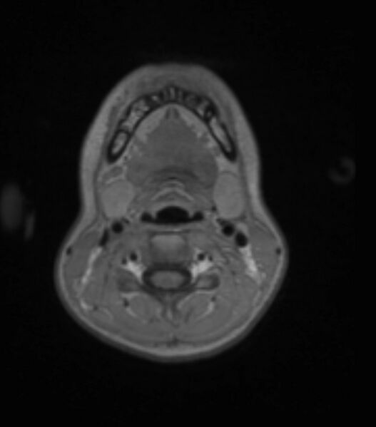 File:Choroid plexus carcinoma (Radiopaedia 91013-108553 Axial T1 C+ 20).jpg