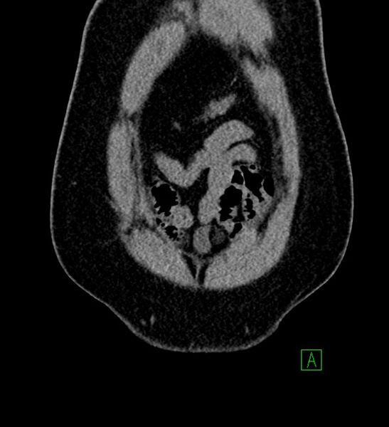File:Chromophobe renal cell carcinoma (Radiopaedia 84286-99573 Coronal non-contrast 15).jpg