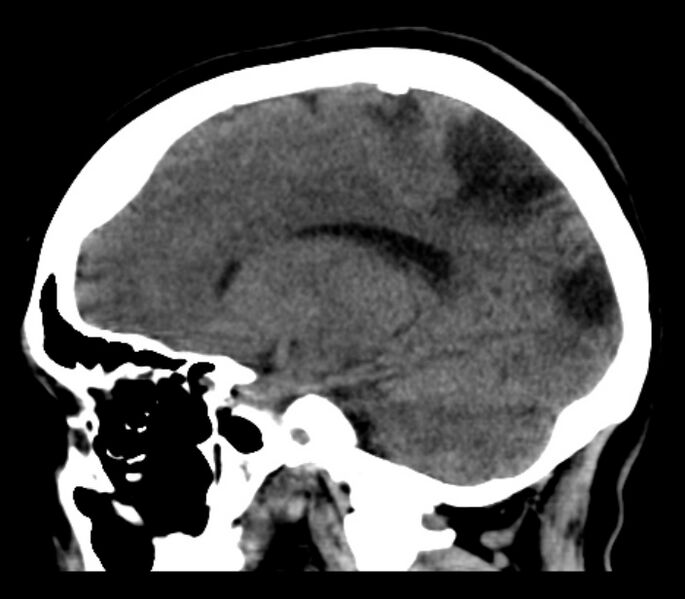 File:Chronic bilateral occipital lobe infarcts (Radiopaedia 31276-31996 C 17).jpg