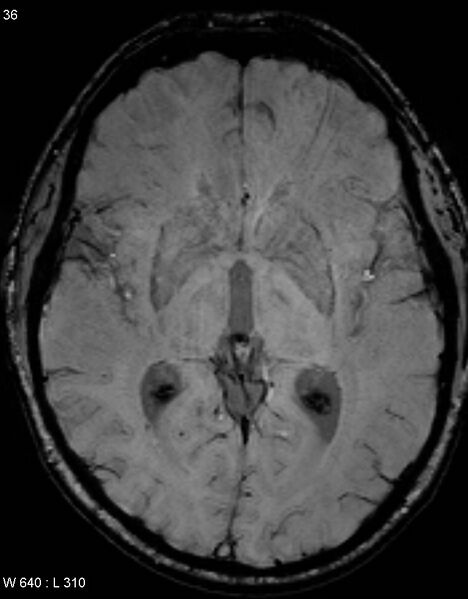 File:Chronic lymphocytic inflammation with pontine perivascular enhancement responsive to steroids (CLIPPERS) (Radiopaedia 37520-39374 Axial SWI 35).jpg