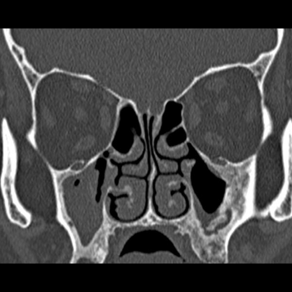File:Chronic maxillary sinusitis (Radiopaedia 27879-28116 Coronal bone window 26).jpg