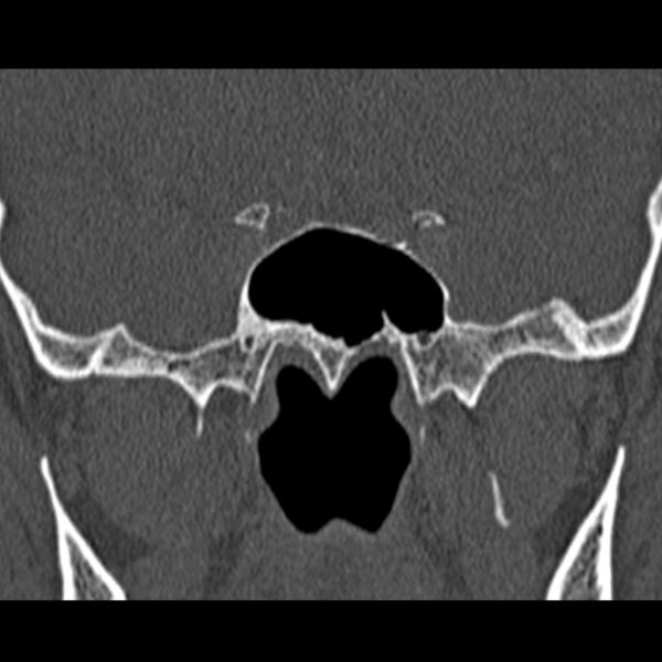 File:Chronic maxillary sinusitis (Radiopaedia 27879-28116 Coronal bone window 46).jpg