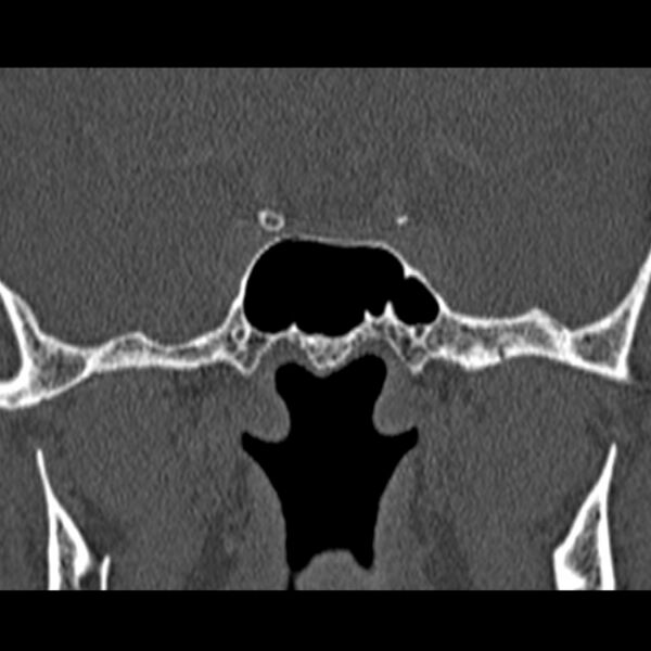 File:Chronic maxillary sinusitis (Radiopaedia 27879-28116 Coronal bone window 49).jpg