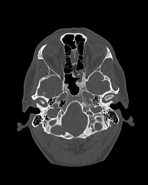 File:Chronic maxillary sinusitis caused by a foreign body (Radiopaedia 58521-65676 Axial bone window 217).jpg