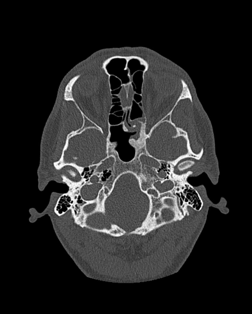 Chronic maxillary sinusitis caused by a foreign body (Radiopaedia 58521-65676 Axial bone window 217).jpg