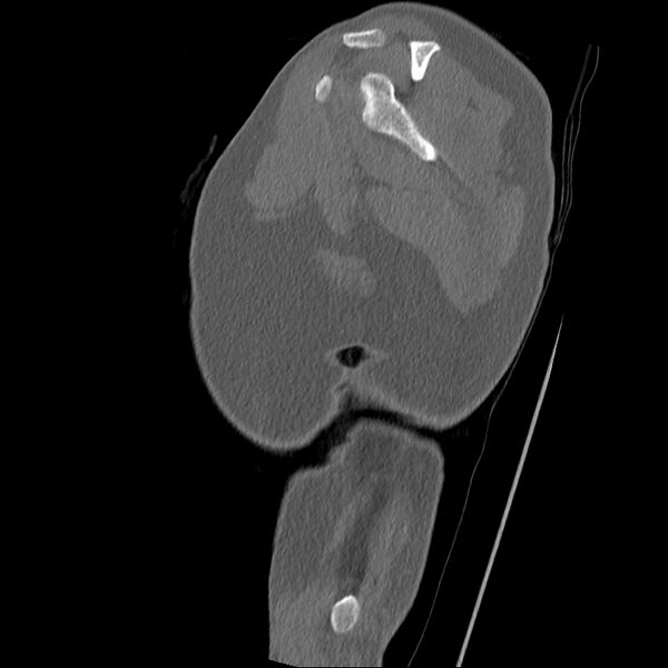 File:Chronic osteomyelitis (Radiopaedia 67597-76998 Sagittal bone window 3).jpg