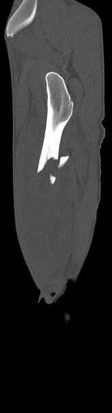 File:Chronic osteomyelitis (with sequestrum) (Radiopaedia 74813-85822 C 94).jpg