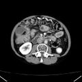 Chronic pancreatitis (Radiopaedia 23132-23172 B 30).jpg