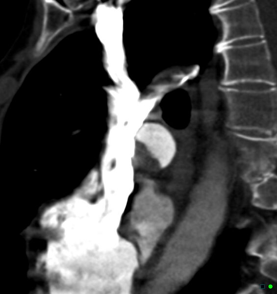 File:Chronic pulmonary embolism (Radiopaedia 17943-17702 Sagittal C+ CTPA 19).jpg