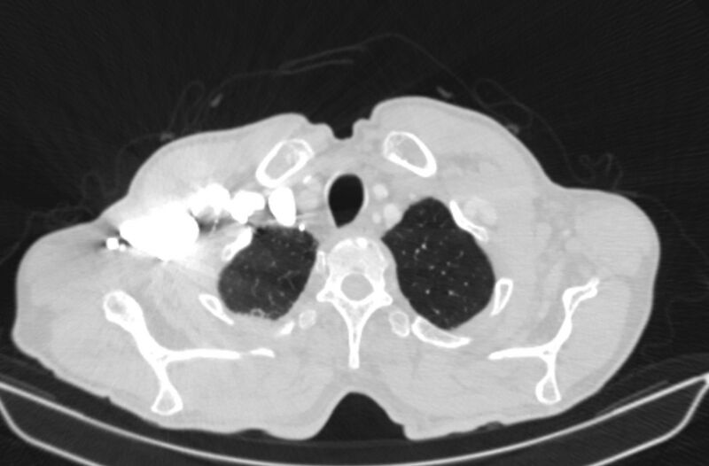 File:Chronic pulmonary embolism (Radiopaedia 91241-108843 Axial lung window 6).jpg