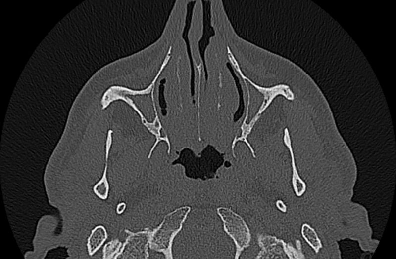 File:Chronic rhinosinusitis (Radiopaedia 65079-74075 Axial bone window 19).jpg