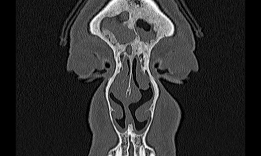 Chronic rhinosinusitis (Radiopaedia 65079-74075 Coronal bone window 6).jpg