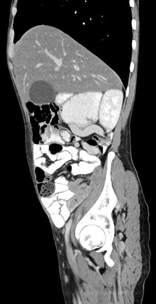 File:Chronic small bowel volvulus (Radiopaedia 75224-86322 C 107).jpg