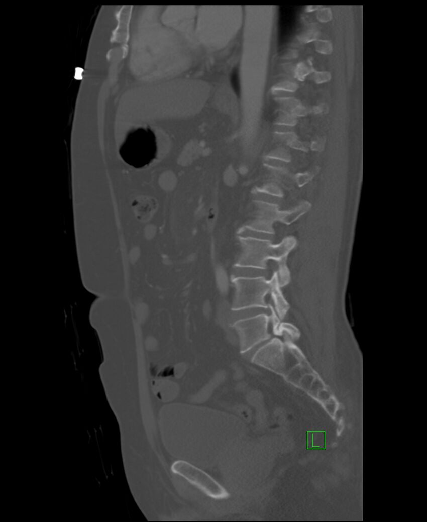 Clear cell renal cell carcinoma (Radiopaedia 85006-100539 Sagittal bone window 27).jpg