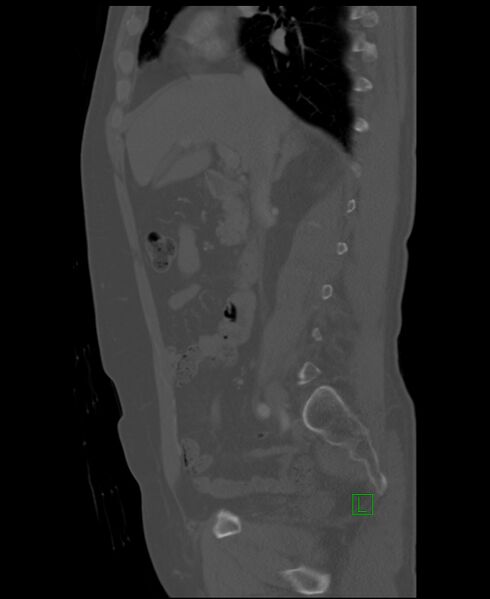 File:Clear cell renal cell carcinoma (Radiopaedia 85006-100539 Sagittal bone window 37).jpg