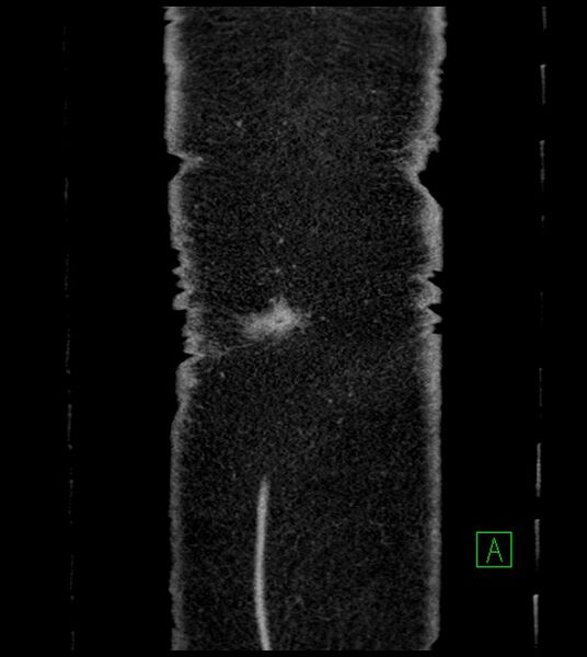 File:Closed-loop small bowel obstruction-internal hernia (Radiopaedia 78439-91096 Coronal non-contrast 104).jpg