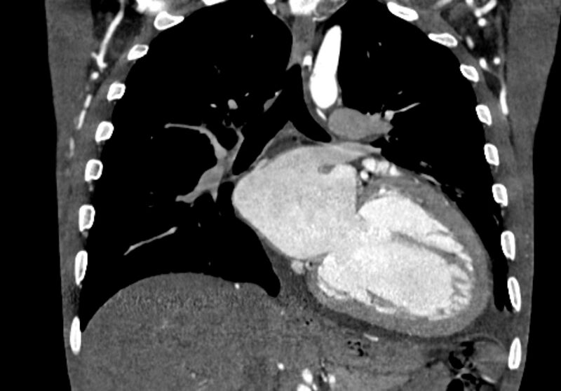 File:Coarctation of aorta with aortic valve stenosis (Radiopaedia 70463-80574 C 131).jpg