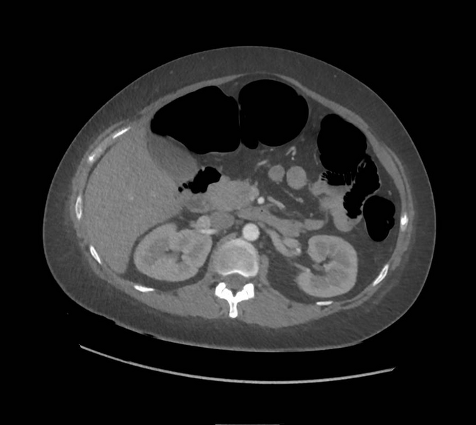 File:Colonic pseudo-obstruction (Radiopaedia 79752-92980 A 70).png