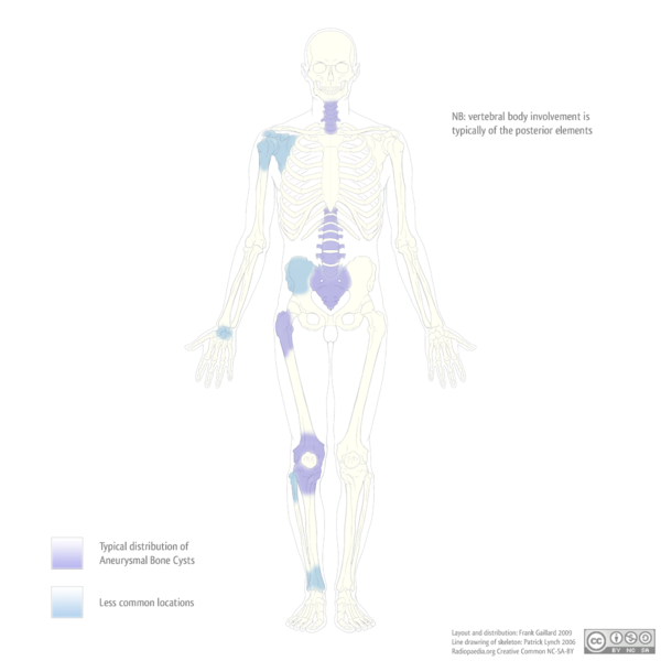 File:Distribution of aneurysmal bone cysts (diagram) (Radiopaedia 7497).png