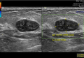 Fibroadenoma of the breast (Radiopaedia 78260).png