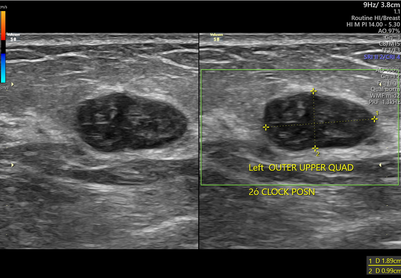 File:Fibroadenoma of the breast (Radiopaedia 78260).png