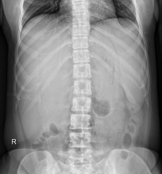 File:Hepatosplenomegaly (x-ray) (Radiopaedia 68167).jpg