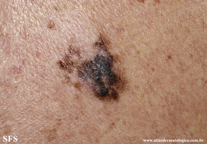 File:Melanoma (Dermatology Atlas 117).jpg
