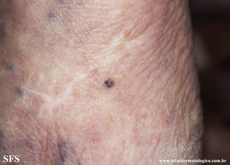 File:Melanoma (Dermatology Atlas 99).jpg