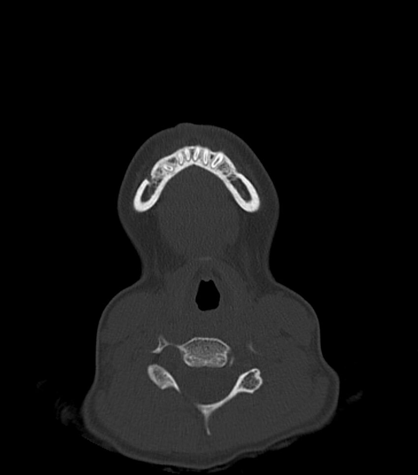 Nasoorbitoethmoid fracture (Radiopaedia 90044-107205 Axial bone window 18).jpg