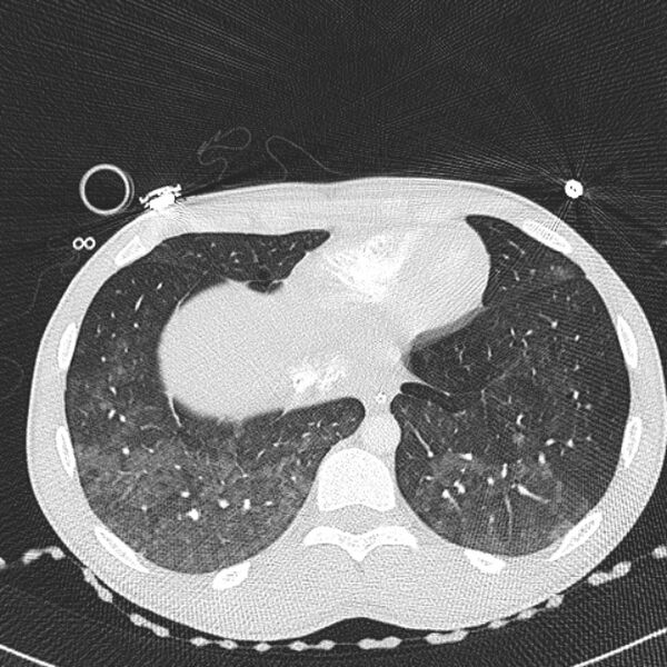 File:Near drowning (pulmonary edema) (Radiopaedia 24685-24958 lung window 67).jpg