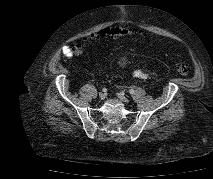 Nephroptosis with inguinal hernia containing perirenal fat (Radiopaedia 56632-63391 C 258).jpg