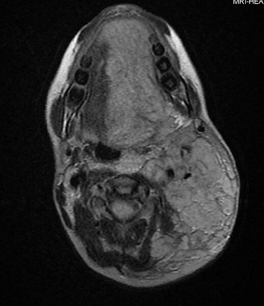 File:Neurofibromatosis type 1 (Radiopaedia 6954-8063 Axial FLAIR 1).jpg