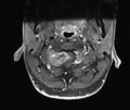 Neurofibromatosis type 1 (Radiopaedia 80355-93740 Axial T1 C+ fat sat 5).jpg