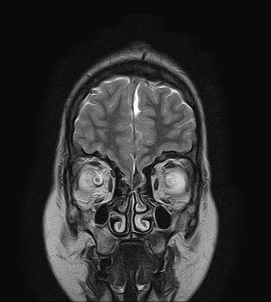 File:Neurofibromatosis type 2 (Radiopaedia 66211-75401 Coronal T2 3).jpg