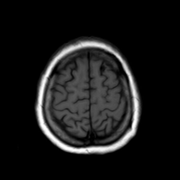 File:Neurofibromatosis type 2 (Radiopaedia 67470-76871 Axial T1 20).jpg