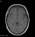 Neurosarcoidosis (Radiopaedia 10930-11351 Axial T1 C+ 9).jpg
