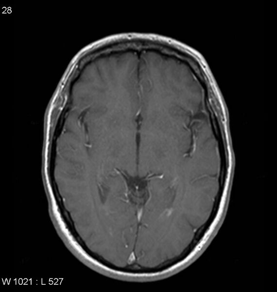 File:Neurosarcoidosis (Radiopaedia 10930-11351 Axial T1 C+ 9).jpg