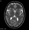 Neurosarcoidosis (Radiopaedia 10930-17204 Axial T2 10).jpg